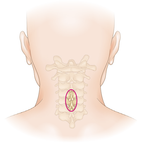 MIST-OPERA の切開範囲 — 1椎間のみピンポイント露出（約3cm）