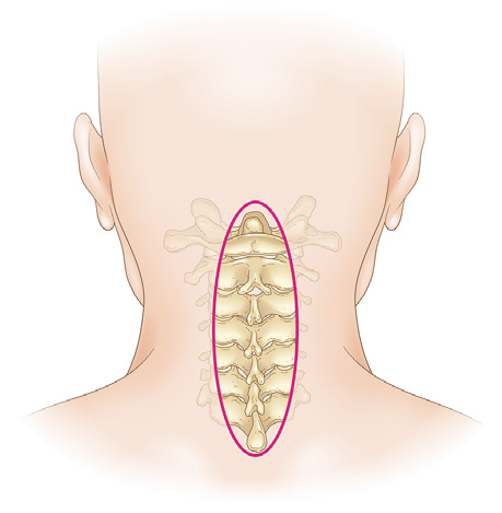 従来法の切開範囲 — 頸椎後方全体を広く露出（10〜15cm）