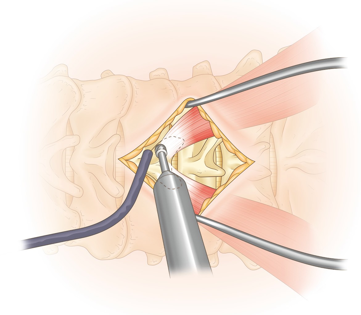 顕微鏡下での3.2mmダイヤモンドドリルによる椎弓削開 — 解剖イラスト