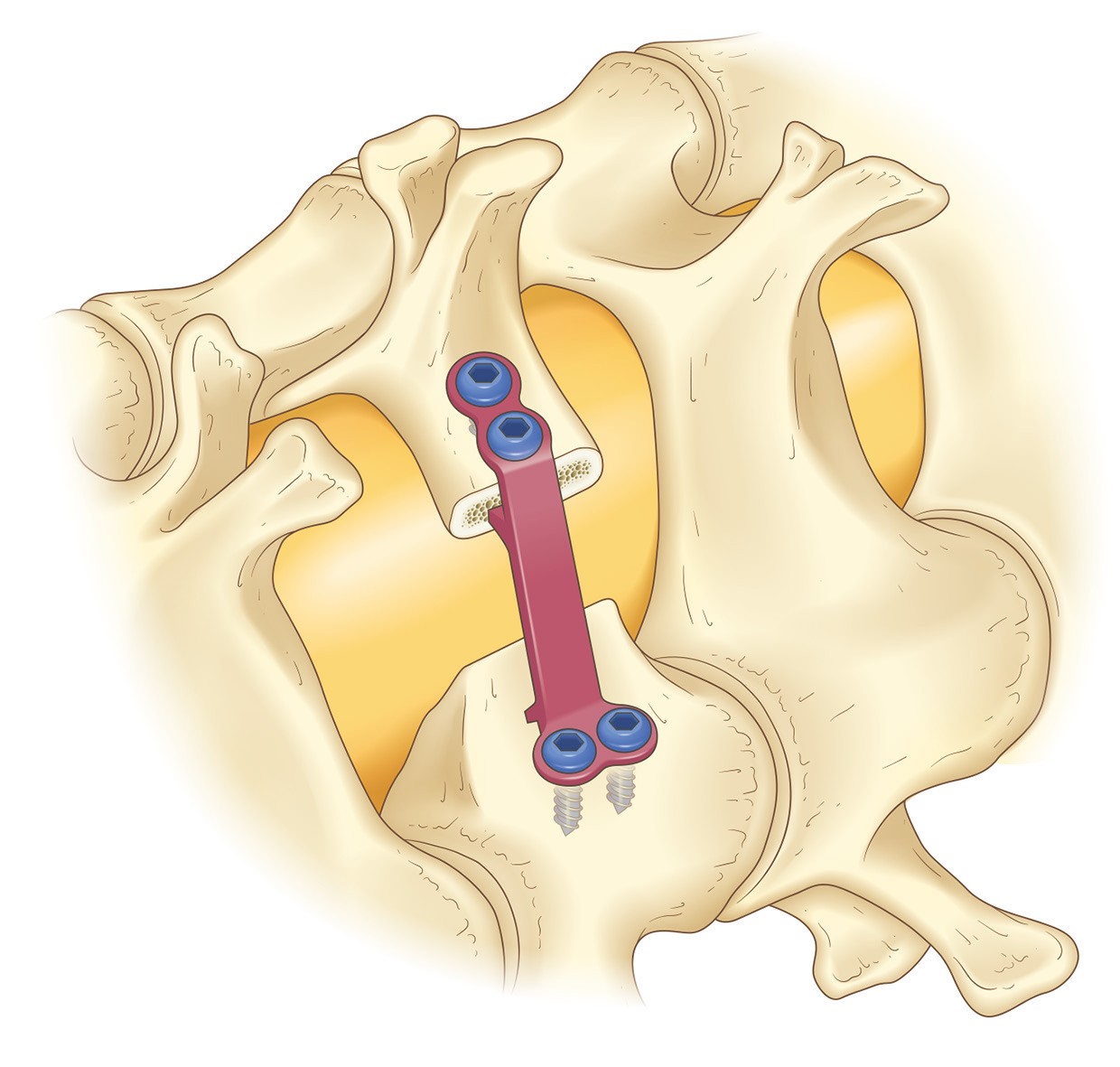 頸椎椎弓形成術イラスト — 削開した椎弓をヒンジプレートで持ち上げて脊柱管を拡大